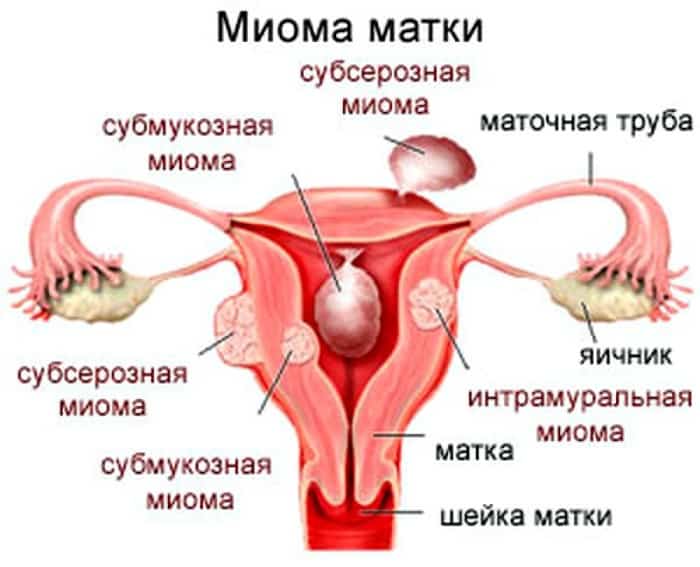 Лечение миомы матки в Москве и Раменском